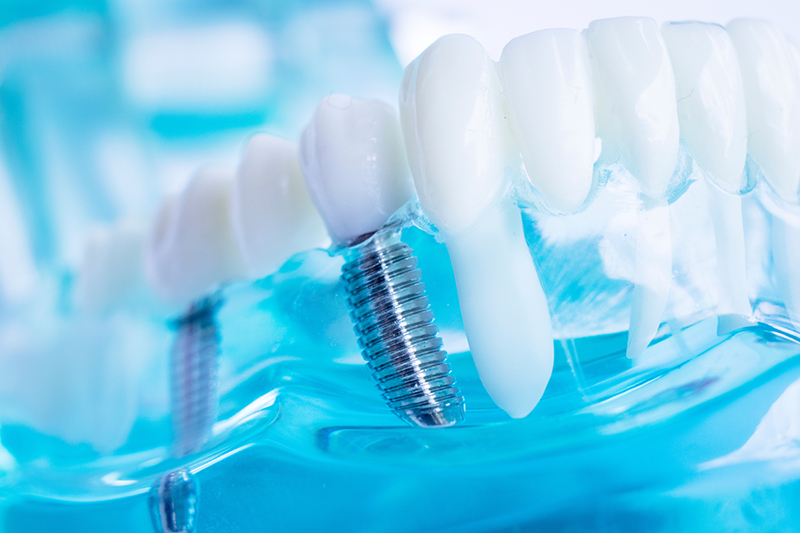 Smiles of Irving | Periodontal Treatment, Extractions and Dental Bridges